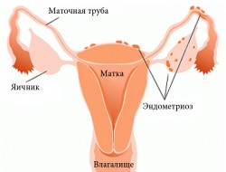 Эндометриоз и беременность