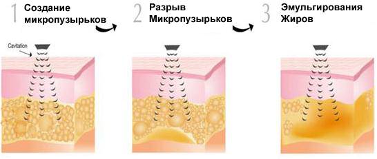 кавитация ультразвуковая