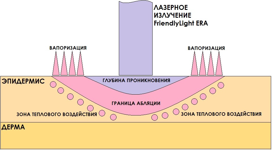 лазерная шлифовка кожи