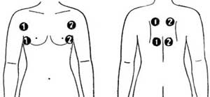 МИОСТИМУЛЯЦИЯ: СХЕМА НАЛОЖЕНИЯ ЭЛЕКТРОДОВ НА МЫШЦЫ ПРЕДПЛЕЧЬЯ И СПИНЫ