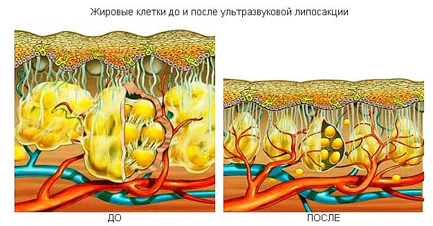 КАВИТАЦИЯ