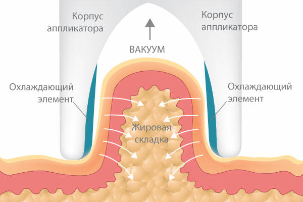 криолиполиз