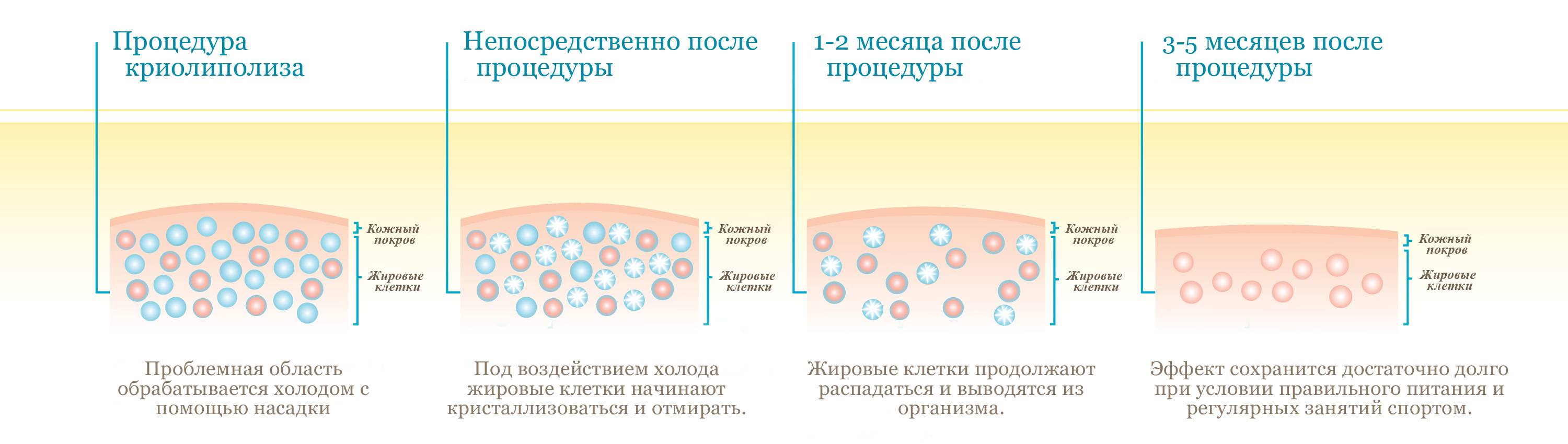 процесс криолиполиза