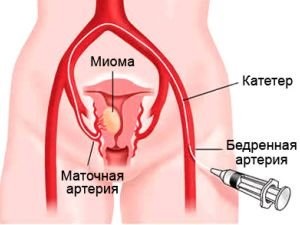 Міома матки і вагітність: особливий контроль від зачаття до пологів