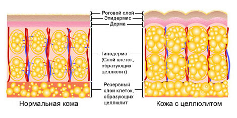 Целлюлит