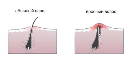 Как выглядят вросшие волосы