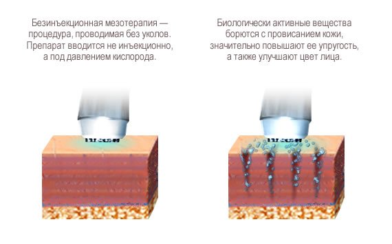 Процес проведення Безін'єкційна мезотерапії особи. Переваги та протипоказання процедури
