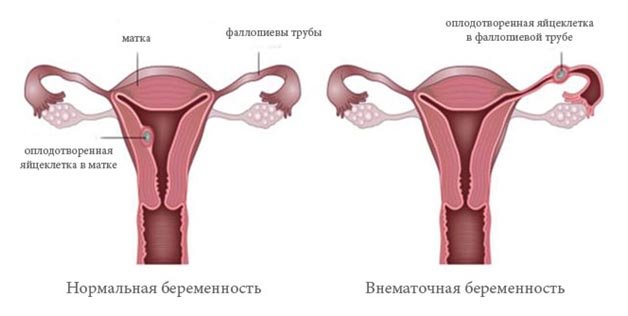 Ознаки позаматкової вагітності на ранніх термінах. Причини виникнення порушення і можливі наслідки