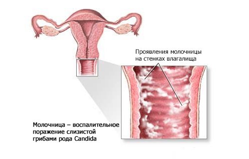 Чим небезпечна молочниця при вагітності? Причини виникнення захворювання. Особливості медикаментозного лікування і використання народних коштів