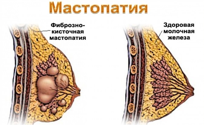 Як лікувати мастопатію народними засобами? Показання до проведення терапії. Рецепти приготування ефективних відварів