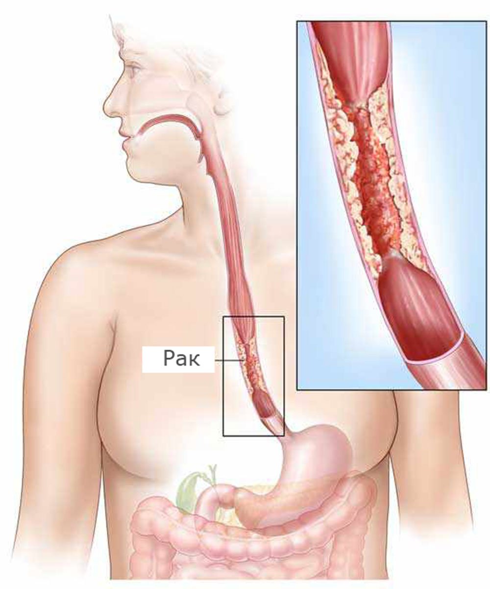 Как вылечить пищевод. Эрозивный рефлюкс-эзофагит. Геморрагический эзофагит. Злокачественные опухоли пищевода.