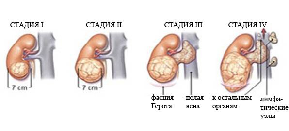 Скільки живуть з раком нирки? Симптоми і причини захворювання. Стадії розвитку хвороби. Методи лікування і профілактика патології