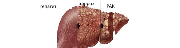 Як проявляється рак печінки? Симптоми захворювання і причини його виникнення. Діагностика онкології на ранніх стадіях