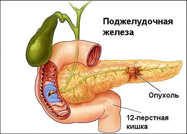 Які симптоми при раку підшлункової залози? Особливості протікання хвороби. Причини виникнення захворювання і його ускладнення