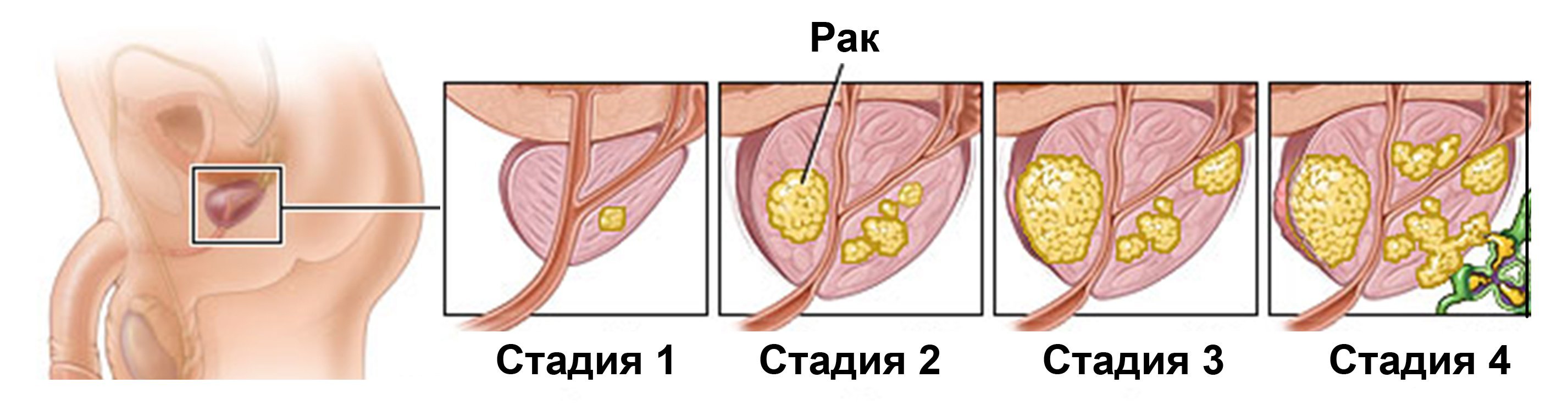 Які симптоми при раку передміхурової залози? Ознаки захворювання на ранніх і пізніх стадіях. Причини виникнення патології і методи її лікування