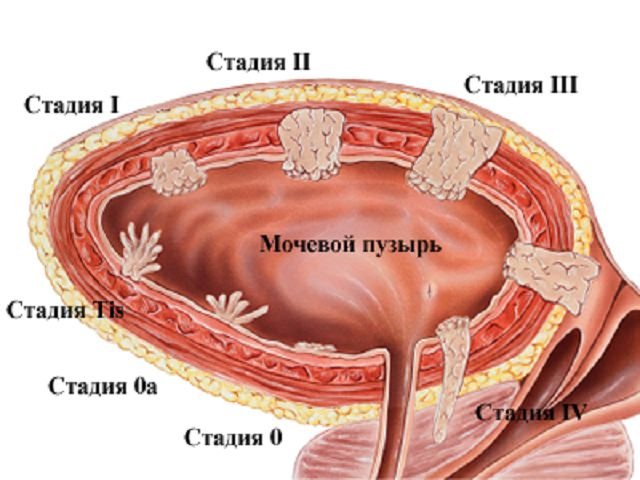 Рак сечового міхура. Причини виникнення і симптоми захворювання. Діагностика і лікування онкології