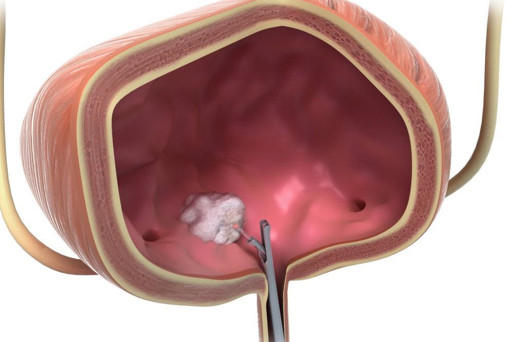 Рак сечового міхура. Причини виникнення і симптоми захворювання. Діагностика і лікування онкології