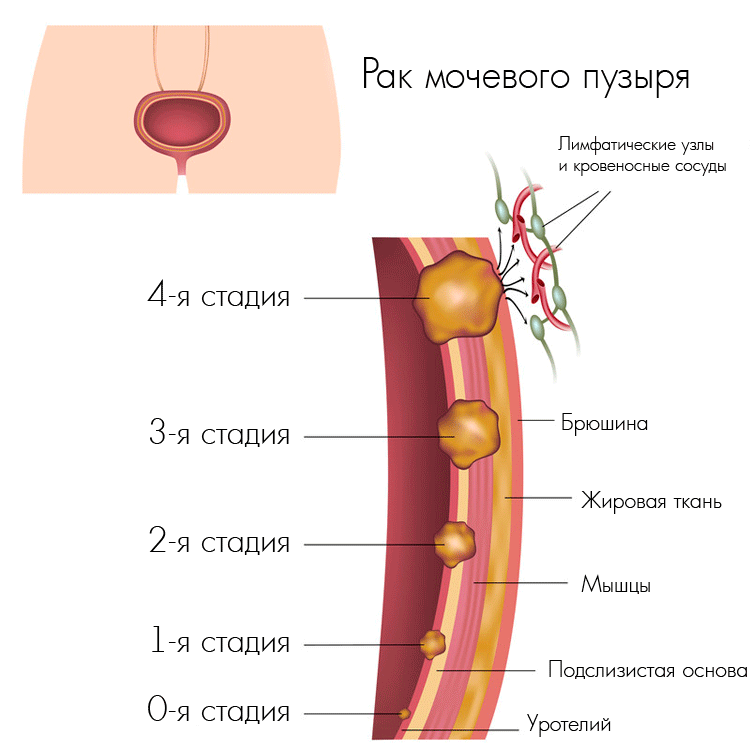 Рак сечового міхура у жінок. Симптоми і причини виникнення захворювання. Стадії розвитку патології і методи її лікування
