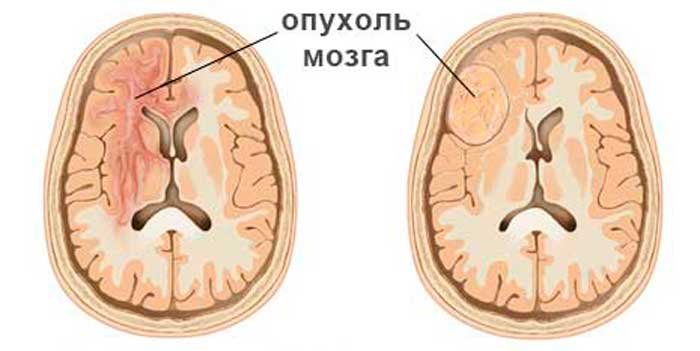 Як проявляється рак головного мозку? Перші ознаки захворювання. Різновиди симптомів на ранніх і пізніх стадіях розвитку онкології