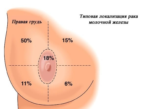 Стадії раку грудей. Особливості протікання захворювання на різних етапах. Діагностика і лікування онкології