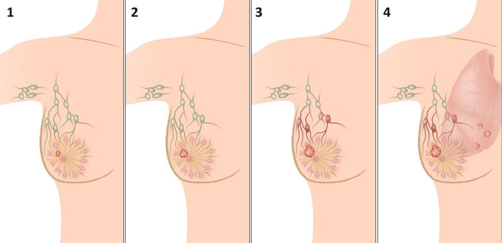 Стадії раку грудей. Особливості протікання захворювання на різних етапах. Діагностика і лікування онкології