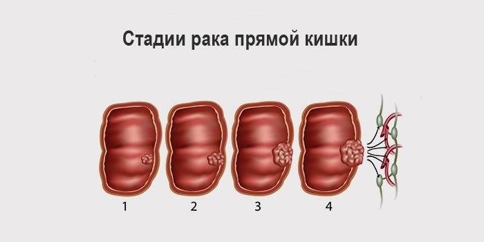 Як проявляється рак кишечника? Перші ознаки захворювання і характерні для нього симптоми. стадії онкології