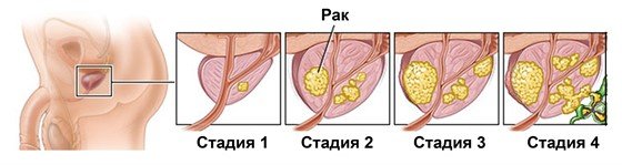 Лікування раку простати. Найефективніші народні, медикаментозні і хірургічні методи позбавлення від захворювання