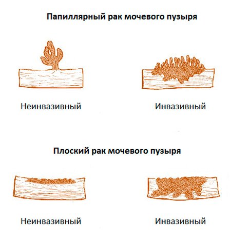 Рак сечового міхура у чоловіків. Симптоми і причини захворювання. Стадії розвитку і види патології. Методи діагностики та лікування недуги