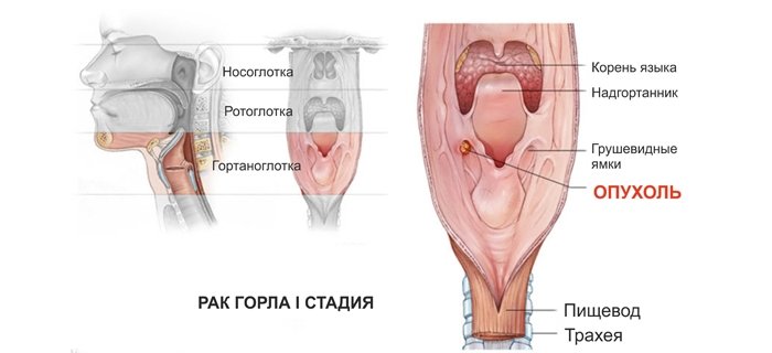 Що таке рак гортані? Симптоми і причини захворювання. Діагностика і методи лікування патології