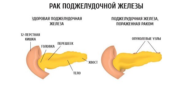 Скільки можна прожити з раком підшлункової залози? Симптоми і причини захворювання. Діагностика і методи лікування онкології