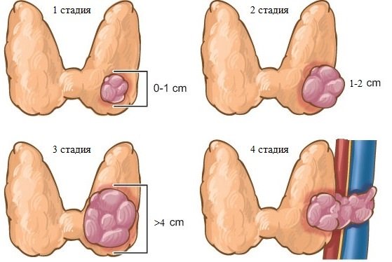 Симптоми і причини раку щитовидної залози. Стадії патології і їх діагностика. Традиційні та народні методи лікування