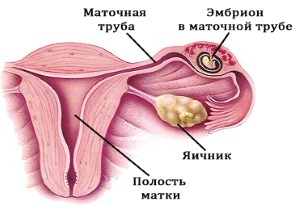 Кіста яєчника і вагітність: зачаття проблематично, виношування під загрозою