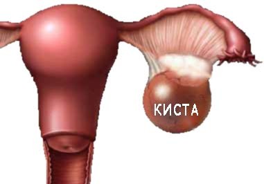 Какие последствия кисты яичников