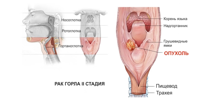Симптомы рака горла и гортани у женщин: вторая стадия