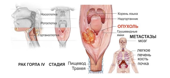 Симптомы рака горла и гортани у женщин: четвертая стадия