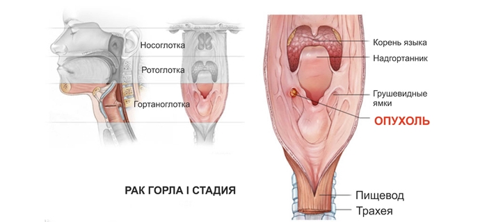 Симптомы рака горла и гортани у женщин: первая стадия