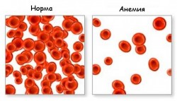 Анемия, причины и симптомы, диагностика и лечение