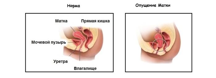 Что означает опущение матки и какое оно бывает