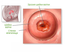 Эрозия матки после родов