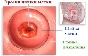 Эрозия шейки матки