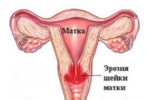 Суппозитории «Гексикон» и эрозия