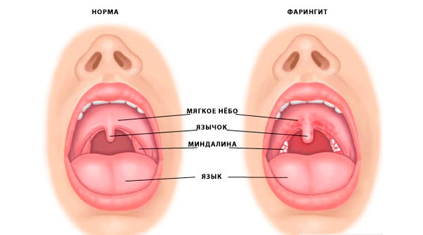 Якщо хвороба схопила за горло, або що таке фарингіт при вагітності