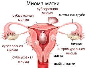 Интрамуральная миома матки - особенности лечения по сравнению с другими видами миоматоза