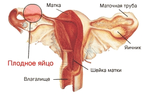 Как происходит внематочная беременность?