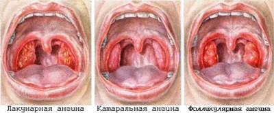 Лакунарная ангина на фото отличия от других видов ангины