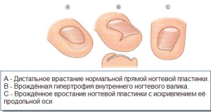 Причины и факторы риска появления вросшего ногтя на ноге