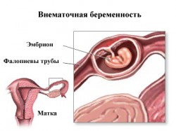 Как поставить диагноз внематочной беременности