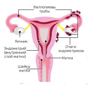 Ендометріоз і вагітність. Хвороба не вирок, стати мамою можливо!