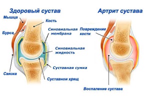 Чим небезпечний артрит при вагітності і як з ним боротися?