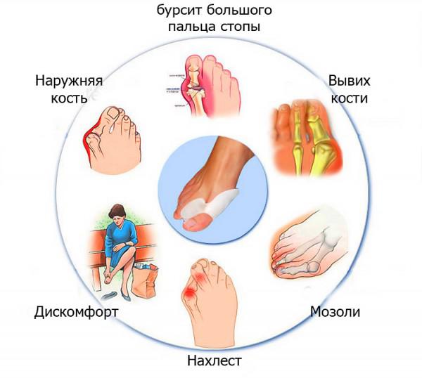 ортопедические разделители для пальцев ног